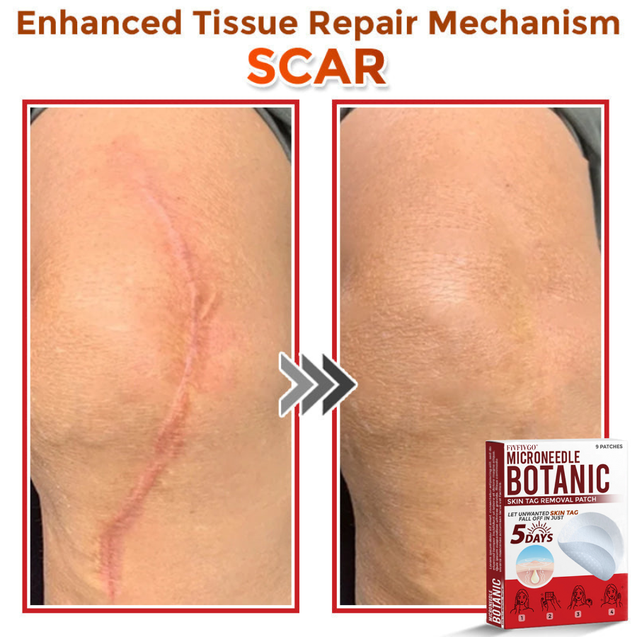 Fivfivgo® MicroNeedle Botanic Skin Tag Removal Patch 🇺🇸 Made in the USA