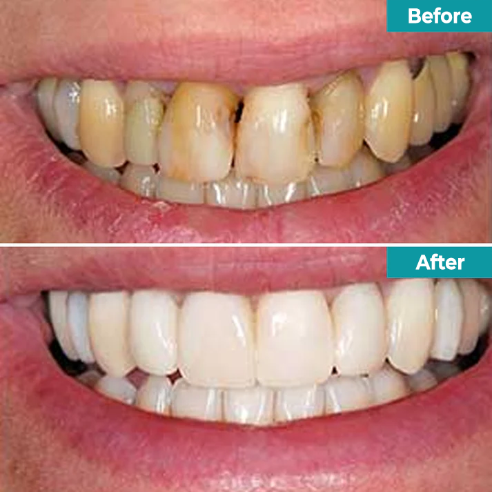Fivfivgo® Instant Teeth Whitening Paint