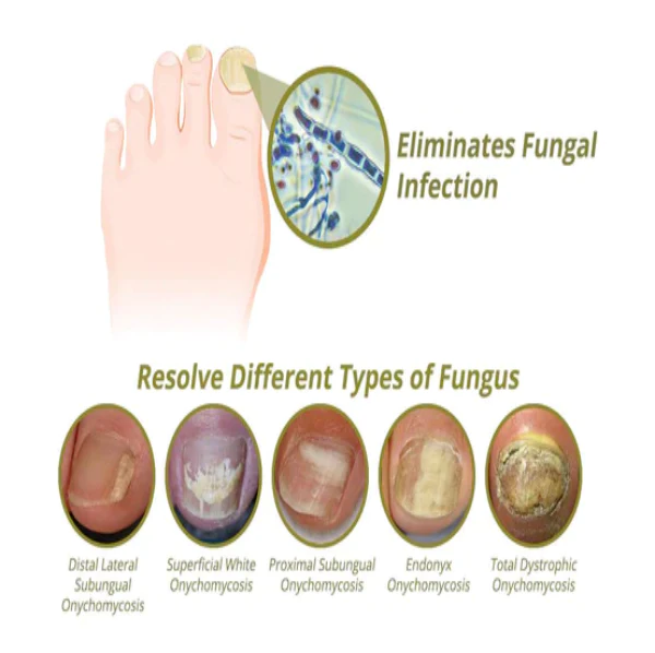 Stylo de traitement de l'onychomycose Fivfivgo™