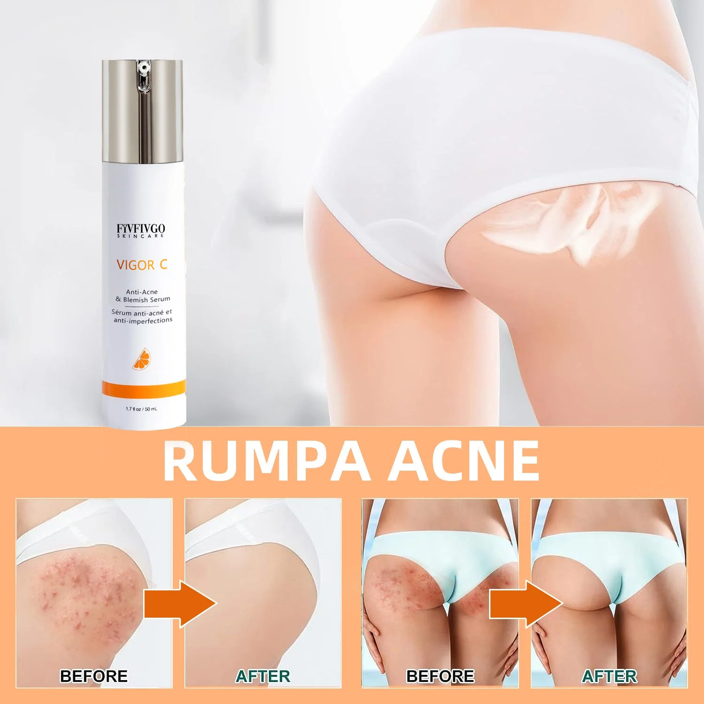 Fivfivgo™ VIGOR C Buttocks Acne Erasing Serum (for Acne & Spots & Acanthosis Nigricans Removal)