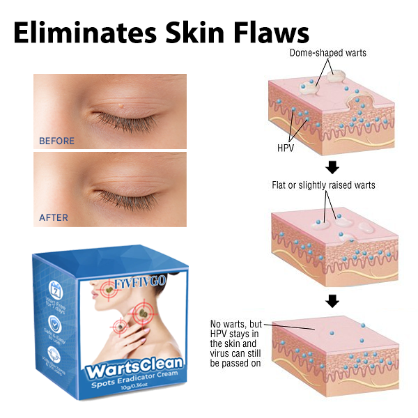 Fivfivgo™ WartsClean Spots Eradicator Cream