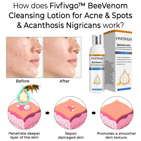 Fivfivgo™ BeeVenom Cleansing Lotion for Acne & Spots & Acanthosis Nigricans