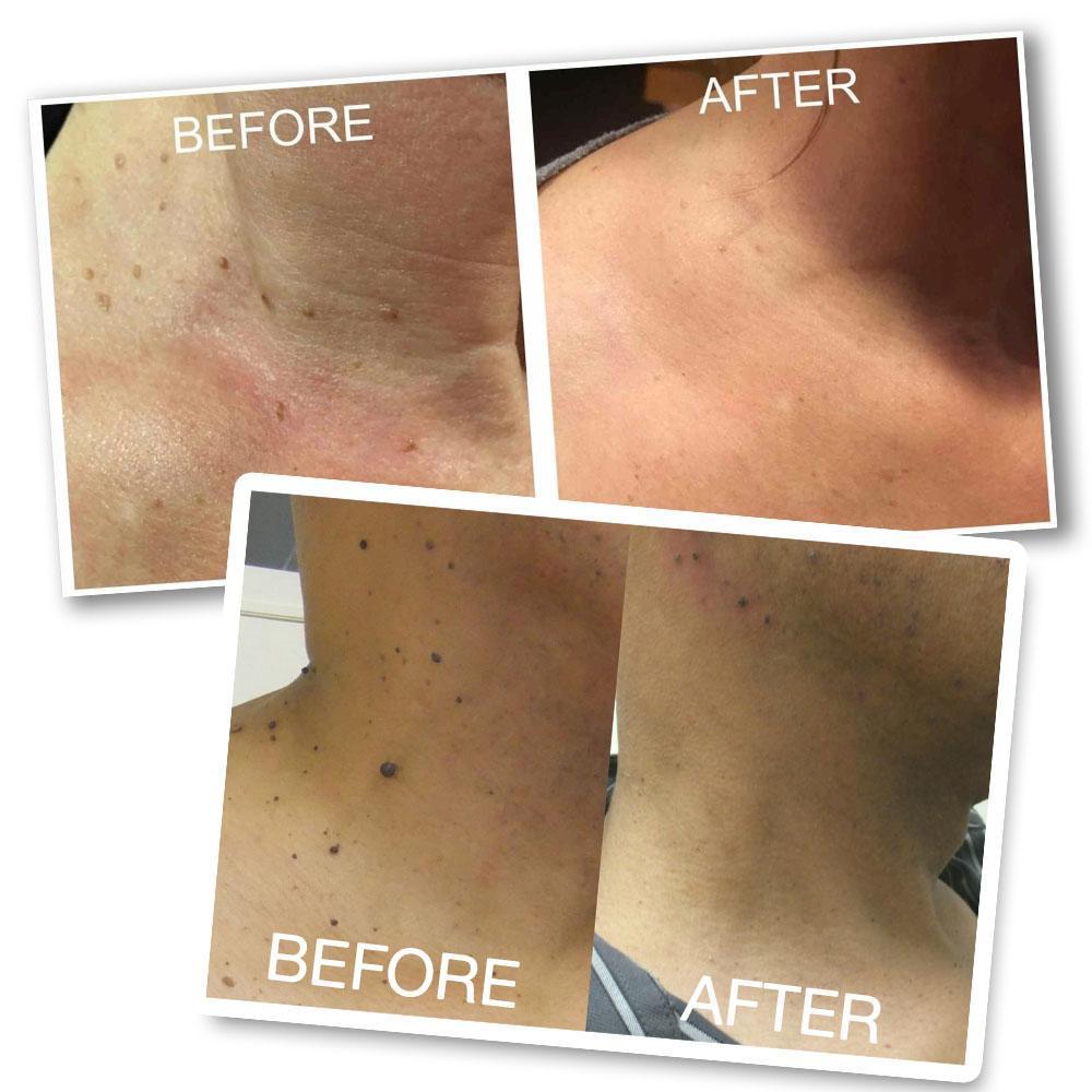 OFFImperfections™ Upgraded Skin Tag Removal