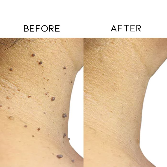 Skin Tag Removal Tool Skin Care Tools Every Day And Night