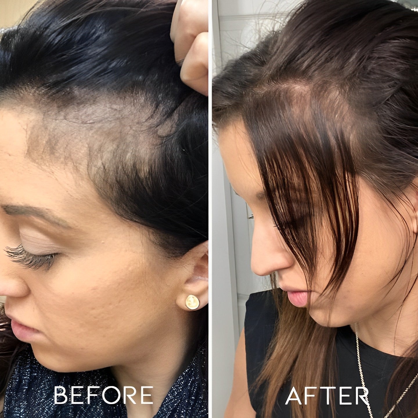 Microneedling Face Roller Personal Care Every Day And Night