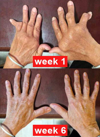 Fivfivgo™ Bee Venom Advanced Joint and Bone Therapy Cream (New Zealand Bee Extract - Specializes in Orthopedic Diseases and Arthritis Pain)