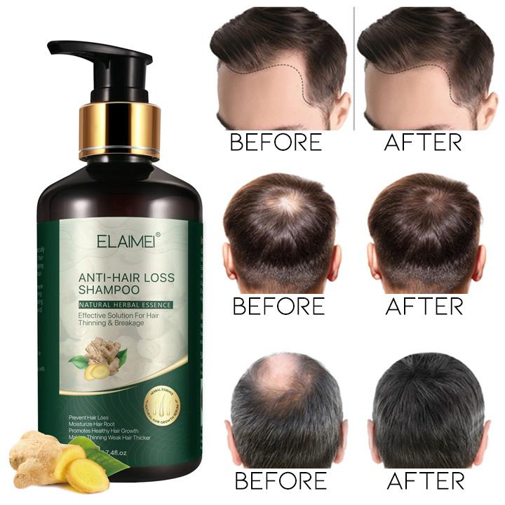 Anti-Hair Loss Shampoo Hair Loss Treatments Every Day And Night 