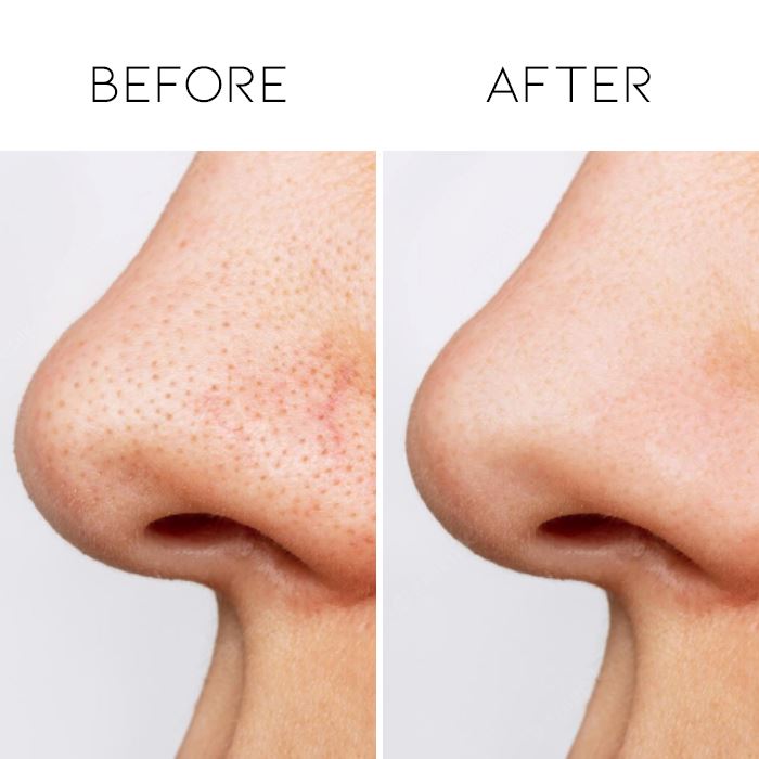 Charcoal Deep Clean Nose Strips Personal Care Every Day And Night 
