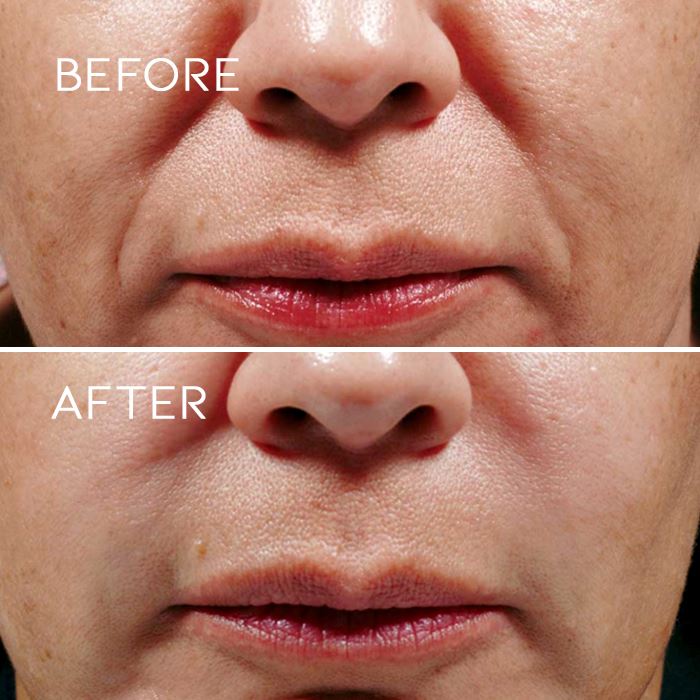 Face Yoga Smile Line Remover Health & Beauty Every Day And Night 