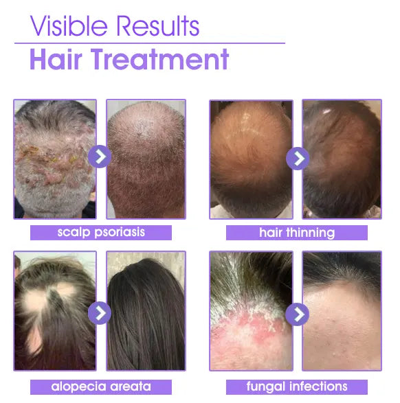 Fivfivgo™ Réparation du follicule pileux Gouttes pour la croissance des cheveux - Atteindre des cheveux plus épais rapidement