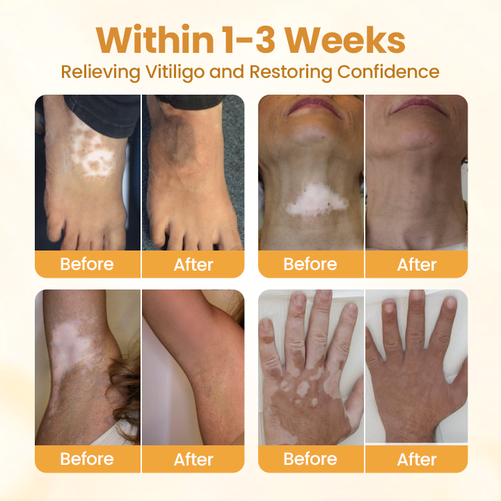 Oveallgo® VitiClear Pro Bee Venom Cream