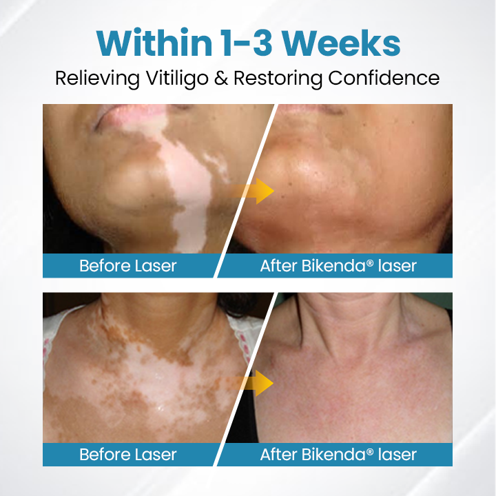 Bikenda® Vitiligo Light Therapy Device