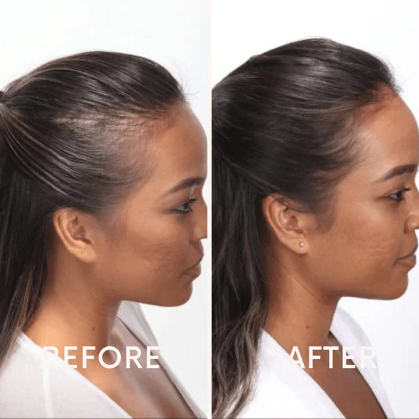 Fivfivgo™ Mobile Lasertherapie-Kappe für Haarwuchs