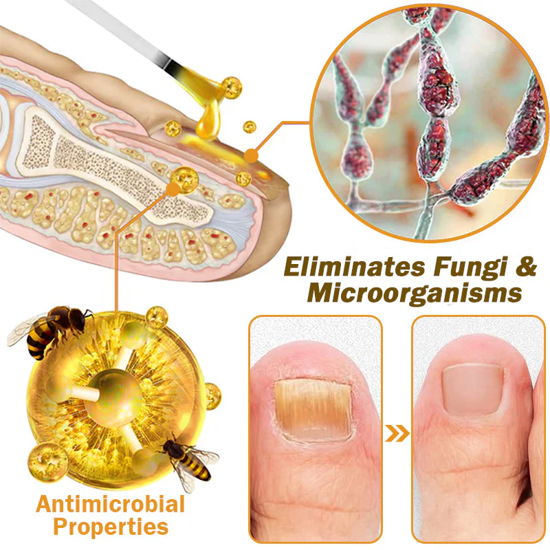 Fivfivgo™ Nagelpilz Bienengift Behandlung Serum