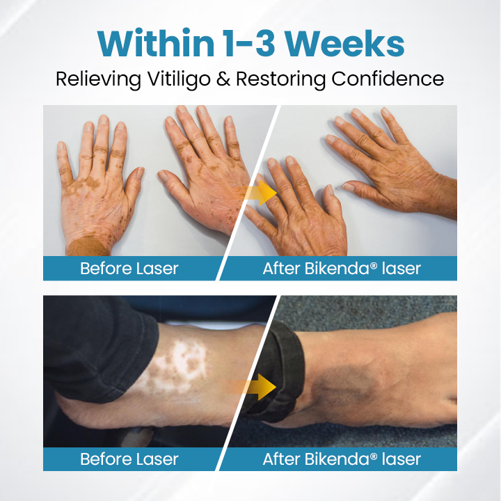 Bikenda® Vitiligo Light Therapy Device
