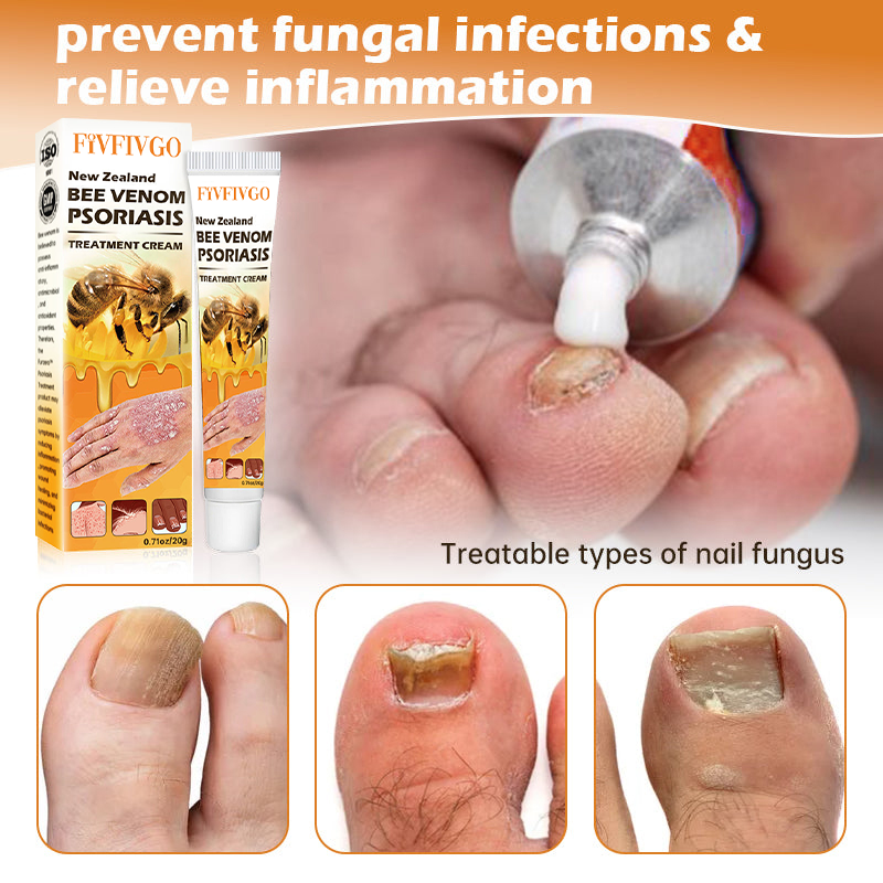 Fivfivgo™ Neuseeland Bienengift Psoriasis Behandlung Creme