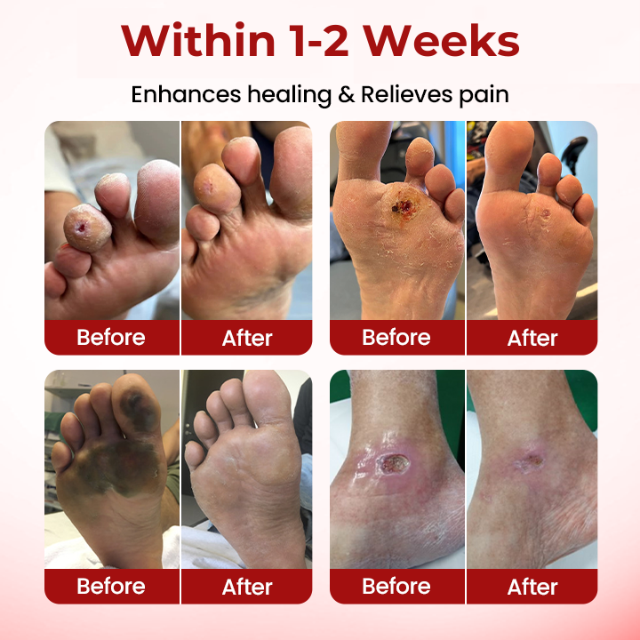 Cvreoz® DiaCare Diabetic Treatment Cream