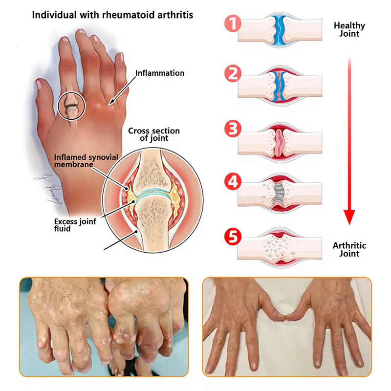 NovaRX®  Bee Venom Pain-Relief Joint Soothing Spray