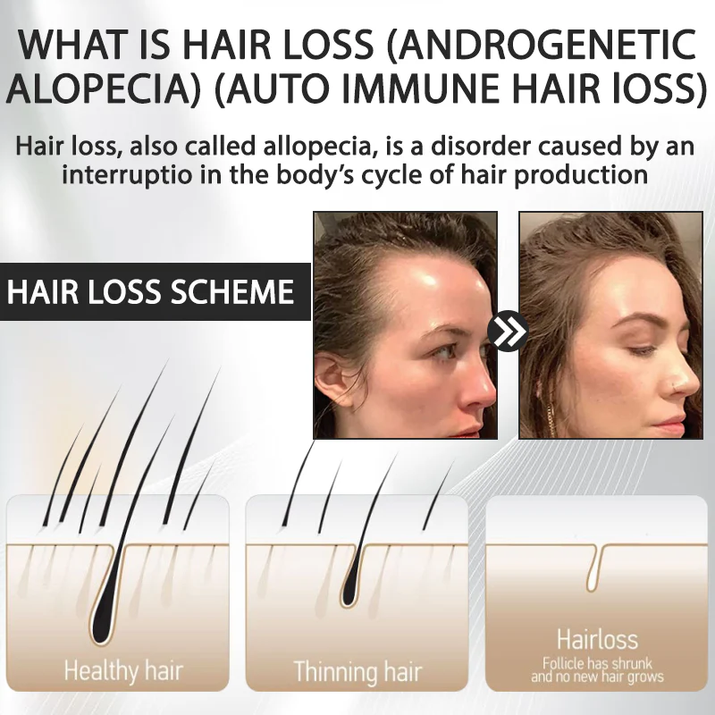 Fivfivgo™ Alopecia Recovery Hair Booster Roll-On