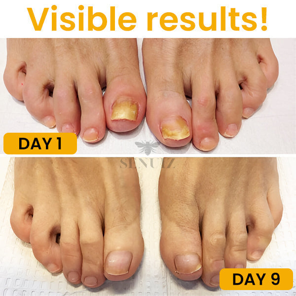 Fivfivgo™ Bee Venom Nail Fungus Treatment Soak