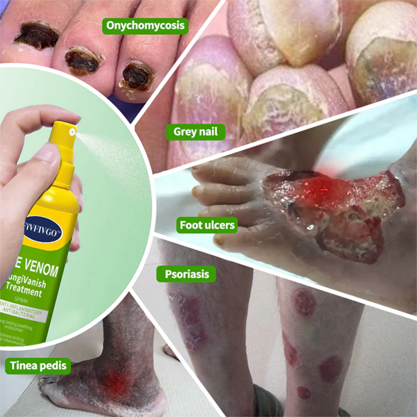 Fivfivgo™ BeeVenom FungiVanish-Behandlungsspray👨‍⚕️ (Fördert die Nagelregeneration, beseitigt wirksam Nagelpilz, Fußpilz und Fußgeschwüre)