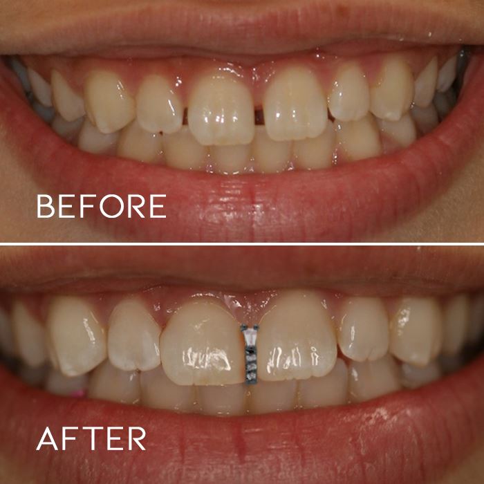 Teeth Gap Filling Grillz Jewelry Apparel & Accessories Every Day And Night 