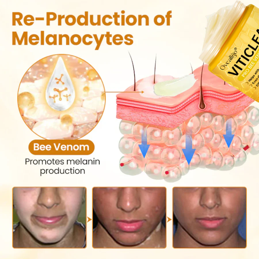 Oveallgo® VitiClear Pro Bee Venom Cream