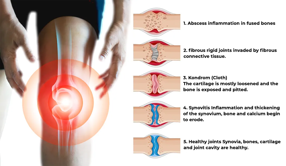 Fivfivgo™ Creme zur Behandlung von rheumatoider Arthritis und Krampfadern
