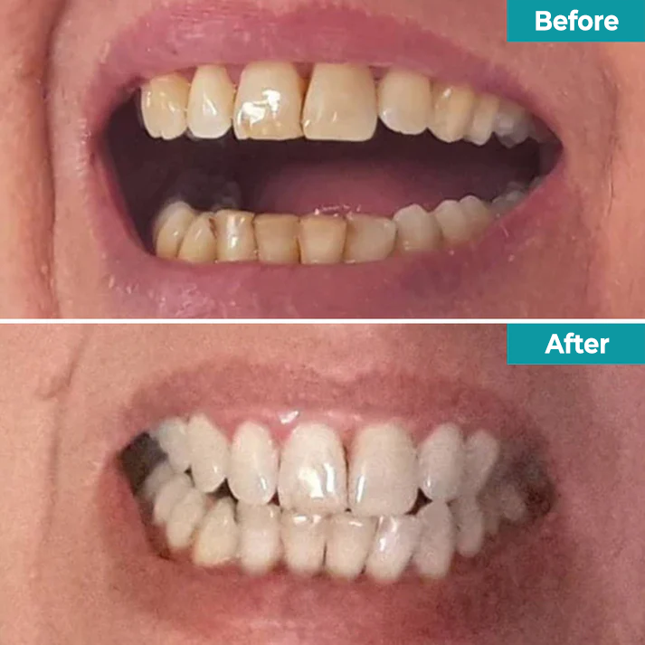 Fivfivgo® Instant Teeth Whitening Paint