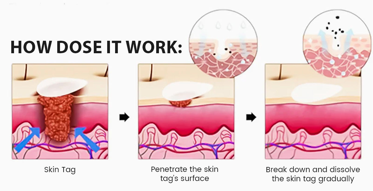 ✅Official Store: Oveallgo® Magnesium MicroPin Target & Clear Wart Removal Patch