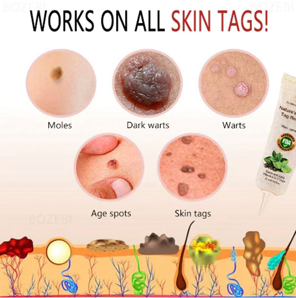 Fivfivgo™ Luonnollinen Skin Tag Remover