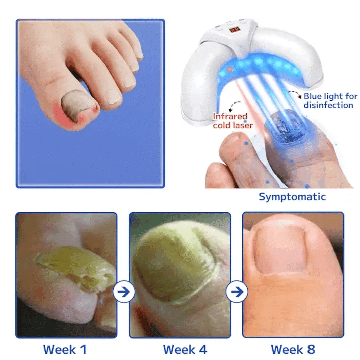 Fivfivgo™ Dispositif Laser de Traitement des Ongles Fongiques