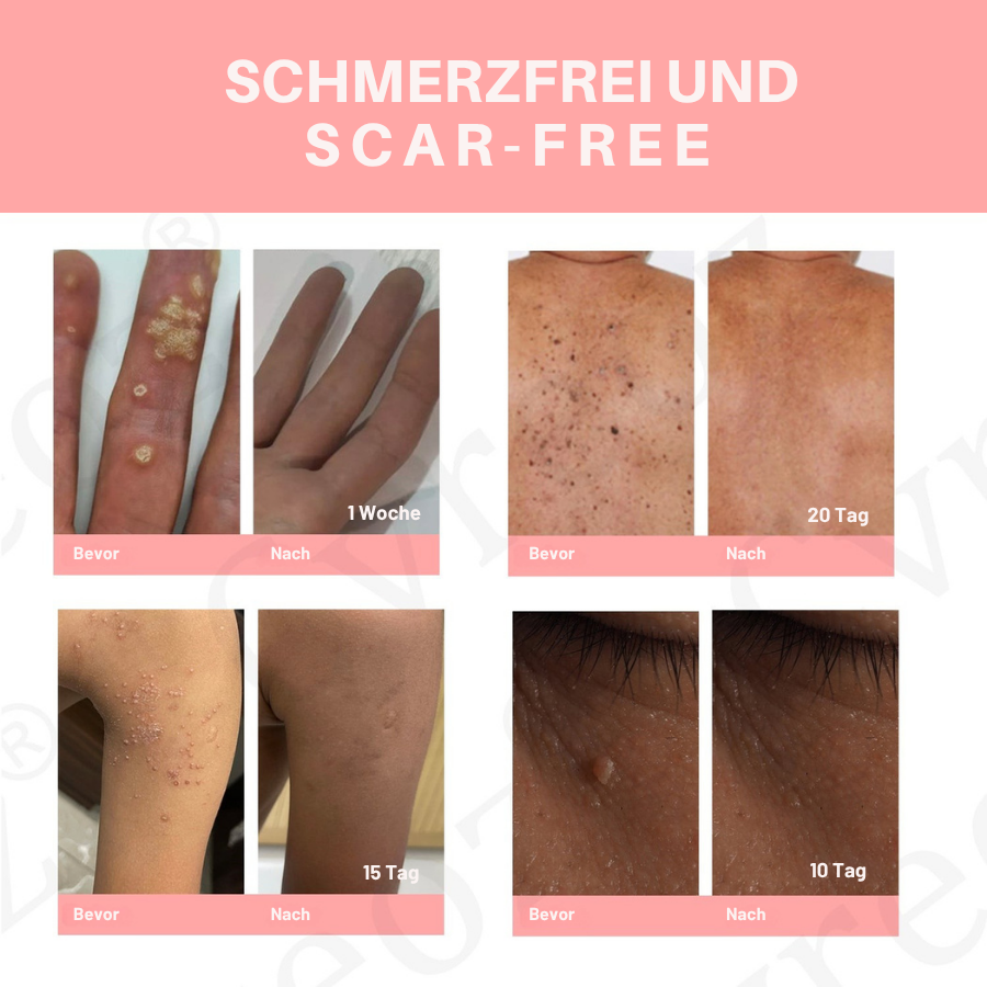 Fivfivgo® Duale Säure Warze & Maulwurfentfernung Serum