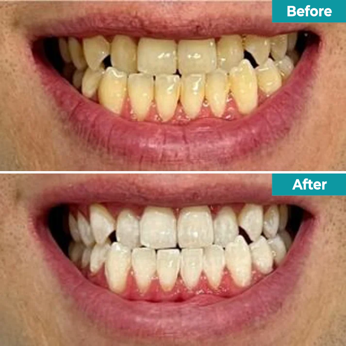 Fivfivgo® Instant Teeth Whitening Paint