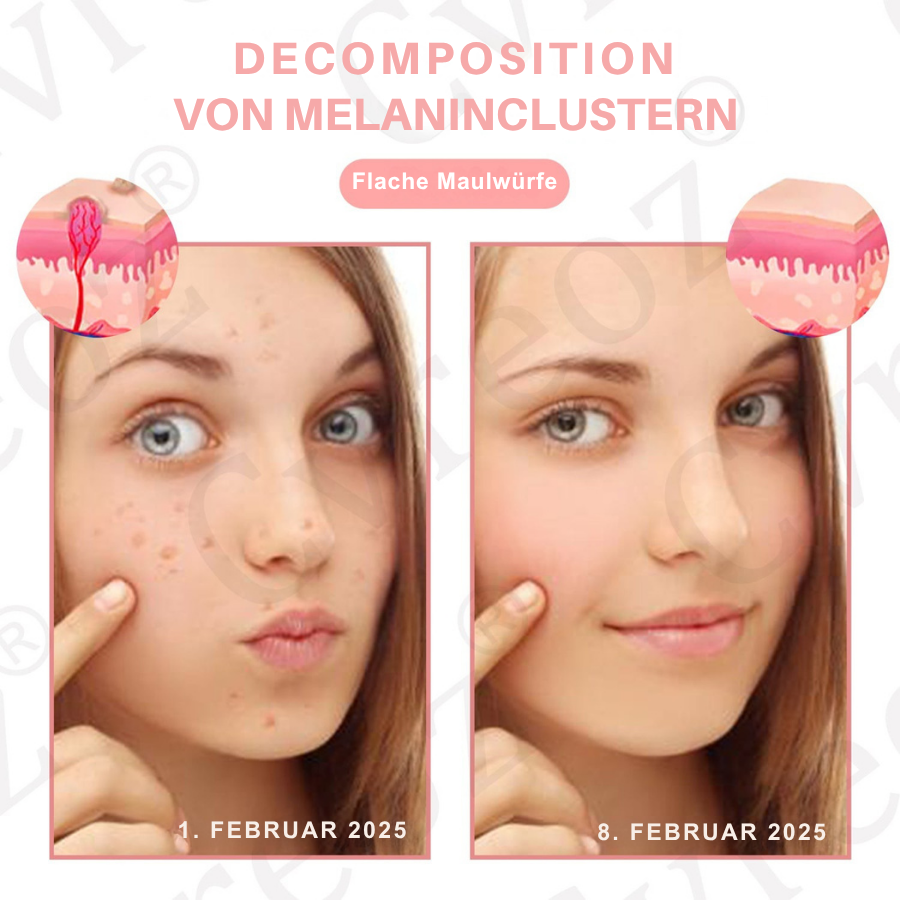 Fivfivgo® Duale Säure Warze & Maulwurfentfernung Serum