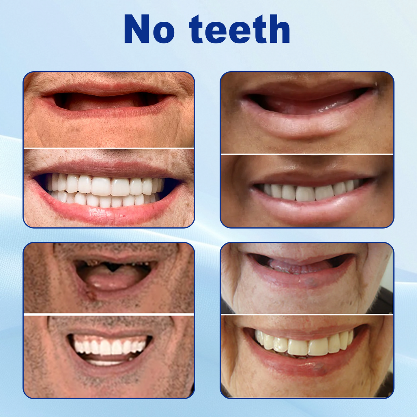 Bikenda® Advanced Customised Full Denture Set