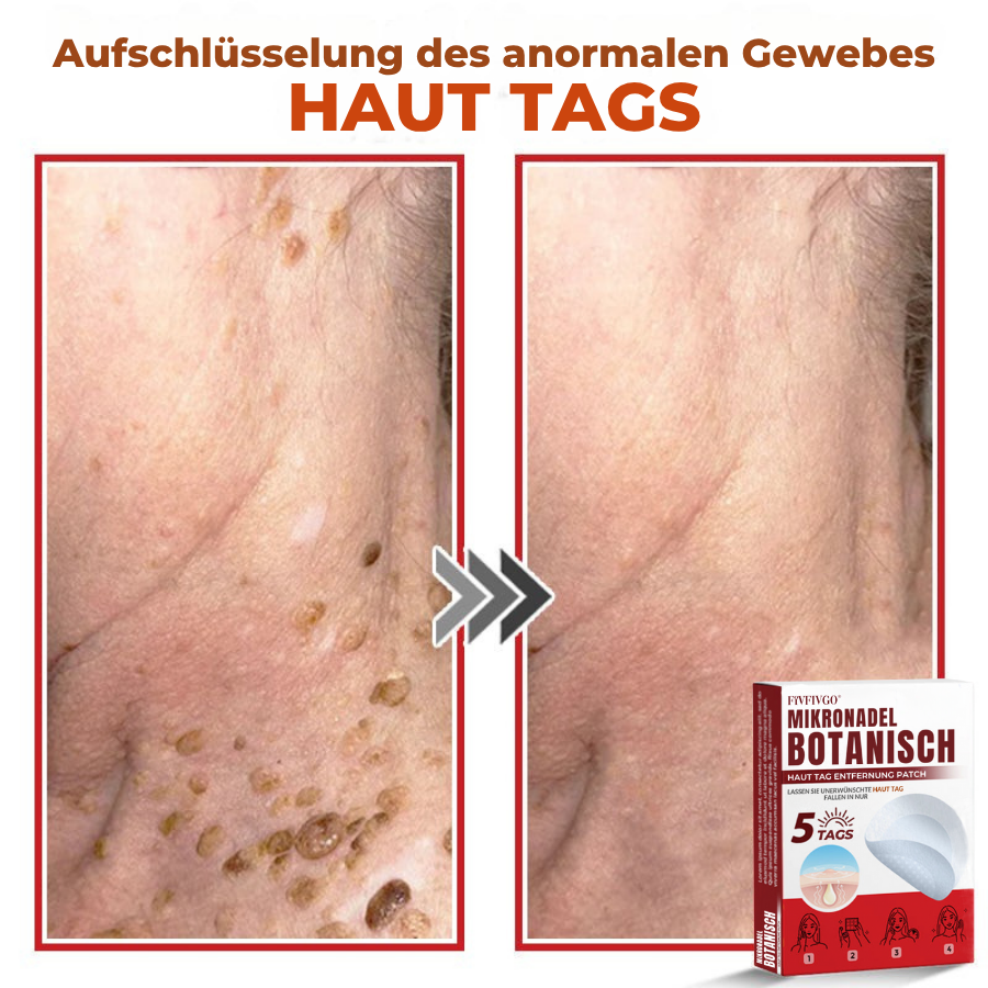 Fivfivgo® MikroNadel Botanisch Haut Tag Entfernung Patch 🇩🇪 Hergestellt in der Germany