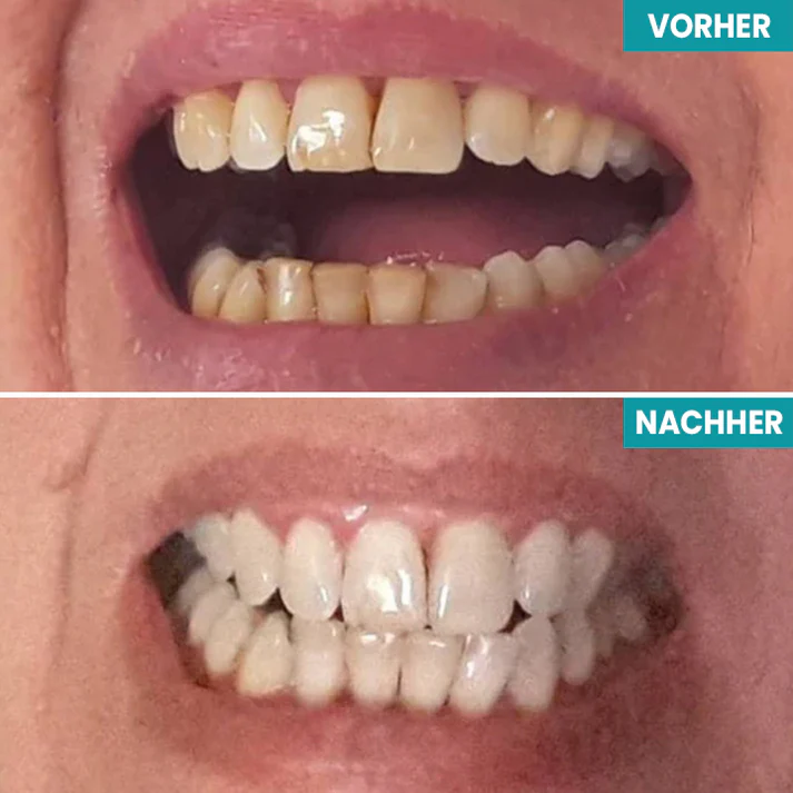 Fivfivgo® Sofortige Zahnaufhellungsfarbe