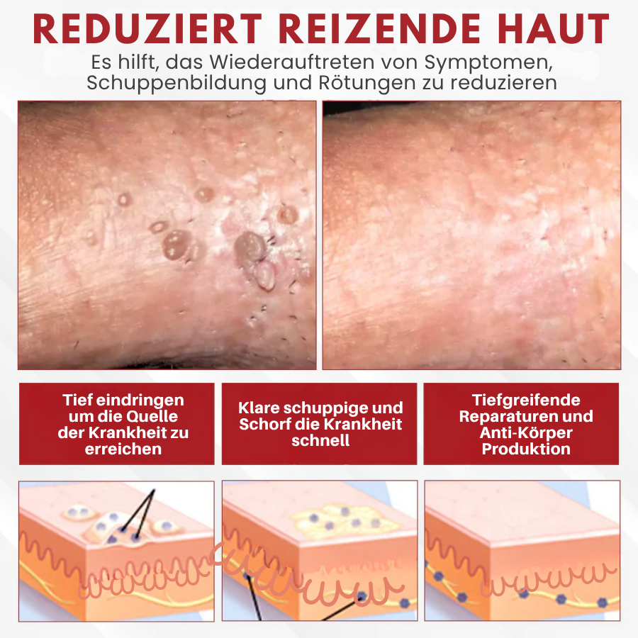 Fivfivgo® Männer HPV Warzen Pflege Spray
