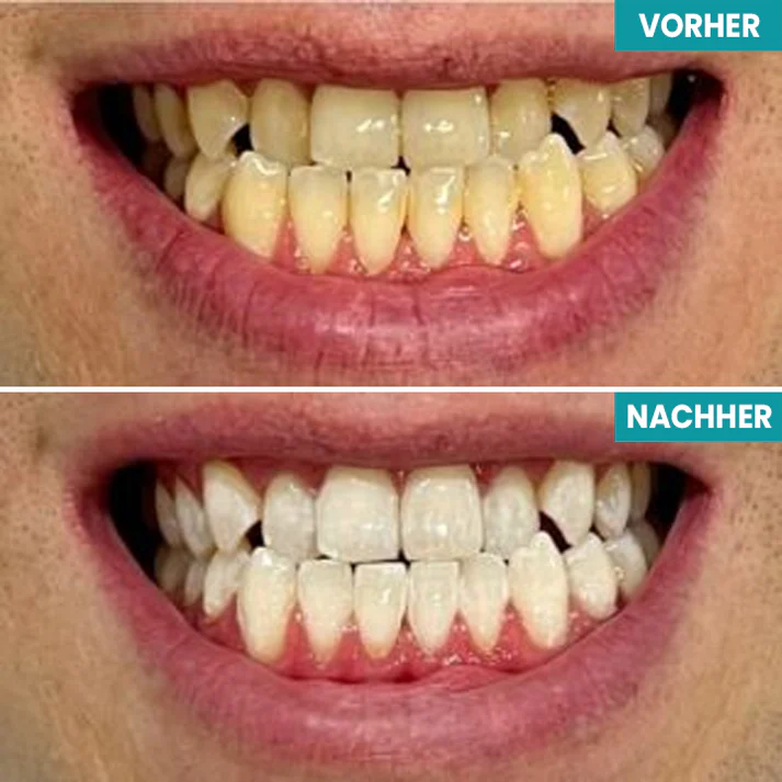 Fivfivgo® Sofortige Zahnaufhellungsfarbe