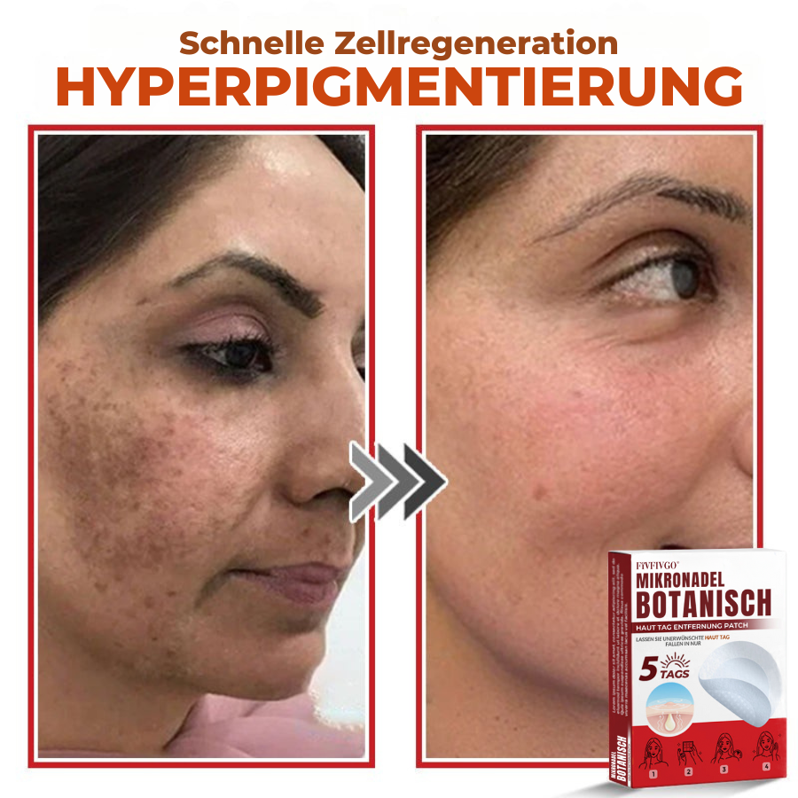 Fivfivgo® MikroNadel Botanisch Haut Tag Entfernung Patch 🇩🇪 Hergestellt in der Germany