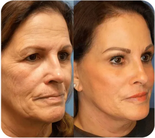 Fivfivgo™ Sofortiger Gesichtsstraffer Kein Filter Primer