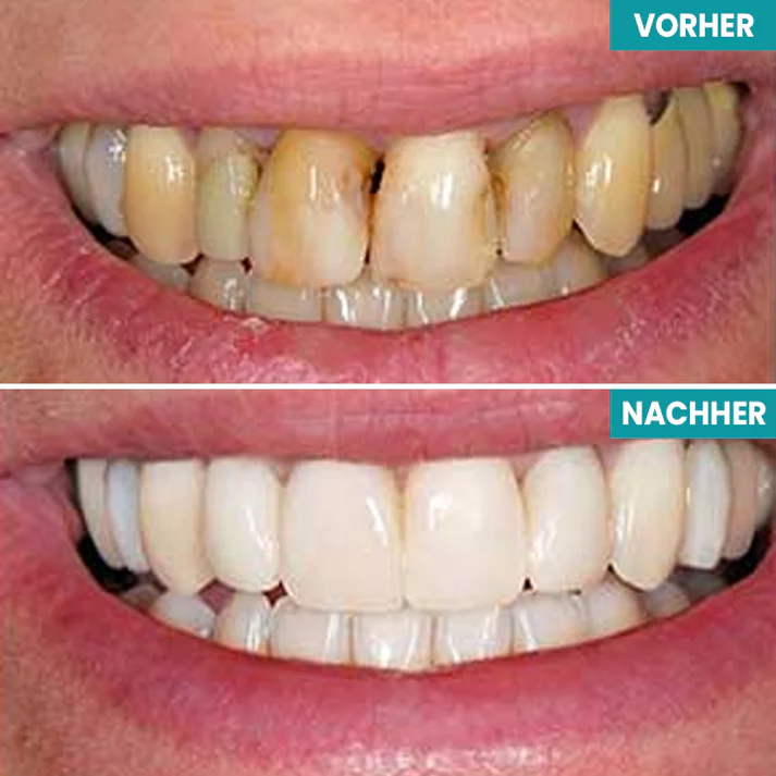 Fivfivgo® Sofortige Zahnaufhellungsfarbe