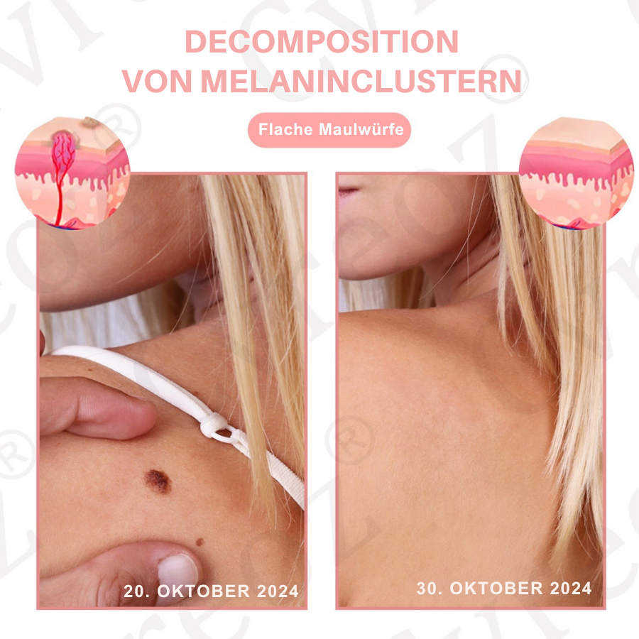 Fivfivgo® Duale Säure Warze & Maulwurfentfernung Serum
