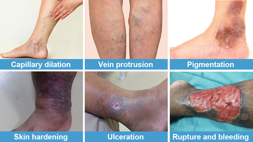 Fivfivgo™ Varicose Veins Treatment Cream
