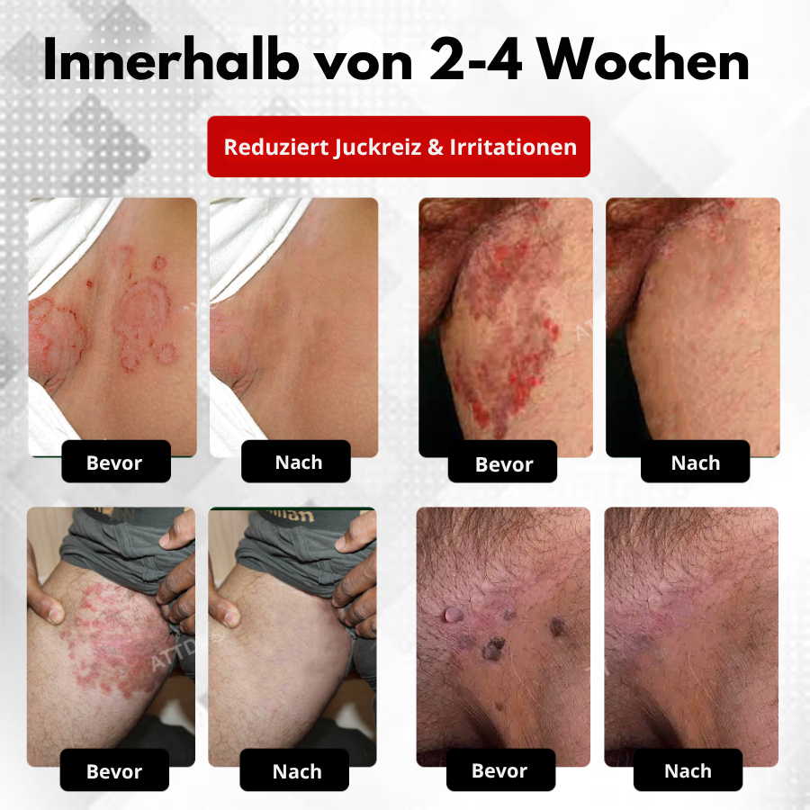 Fivfivgo® Männer HPV Warzen Pflege Spray