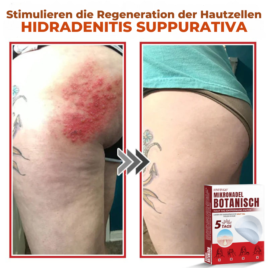 Fivfivgo® MikroNadel Botanisch Haut Tag Entfernung Patch 🇩🇪 Hergestellt in der Germany