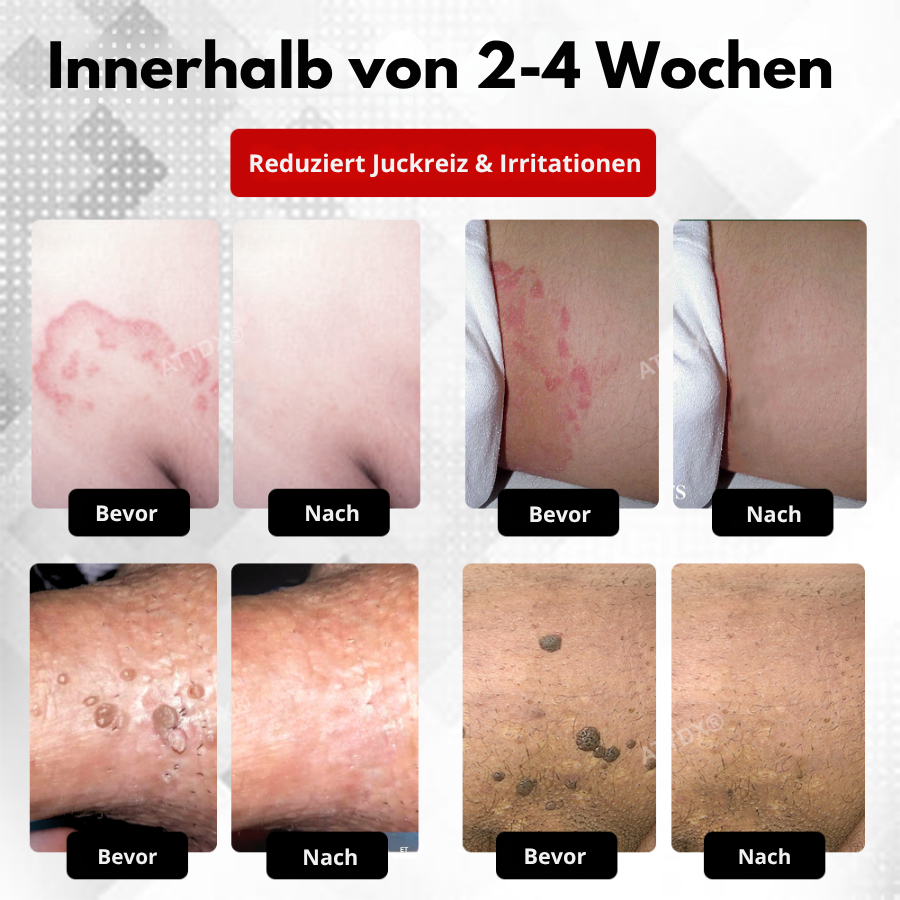 Fivfivgo® Männer HPV Warzen Pflege Spray