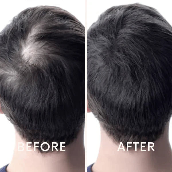 Fivfivgo™ Mobile Laser Therapy Cap pour la repousse des cheveux