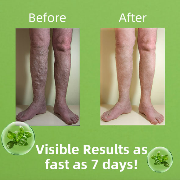 Fivfivgo™ PRO Spray per vene varicose